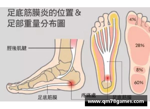 球员筋膜炎：症状、治疗与预防